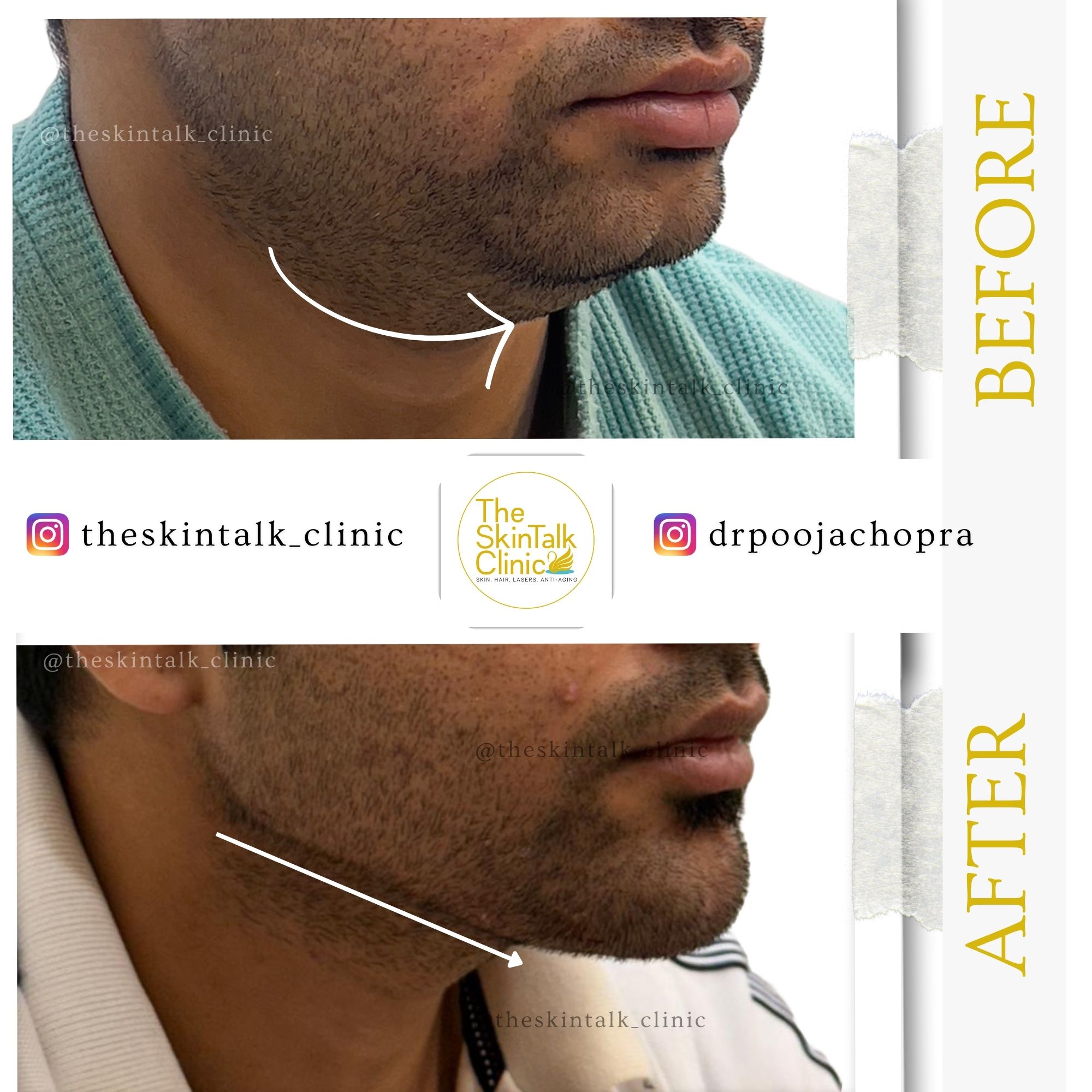 Double Chin Correction