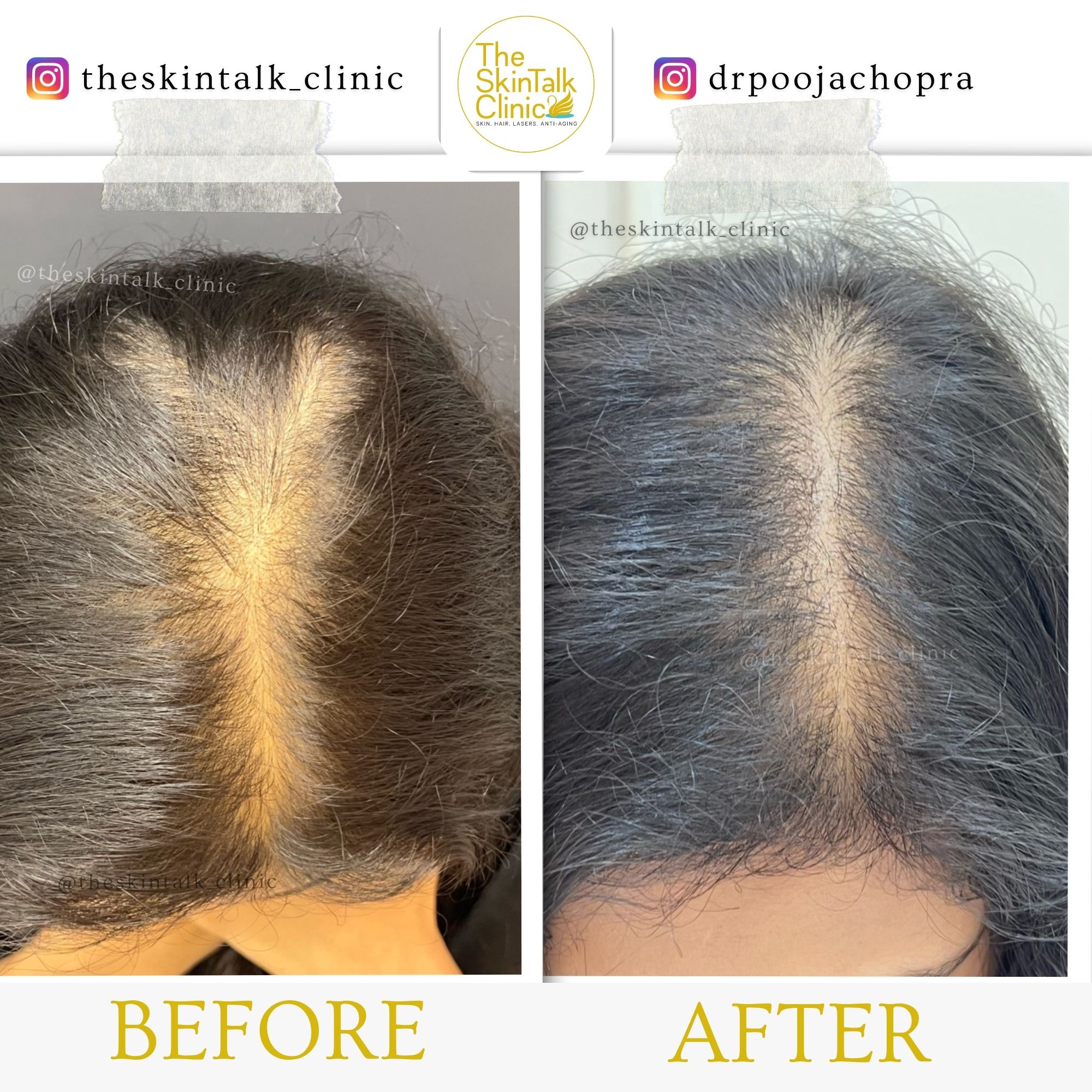 Hair Treatment