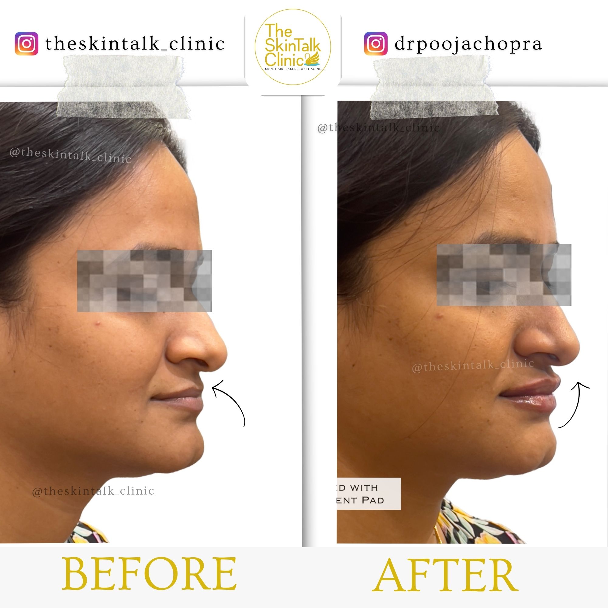 Lip Fillers