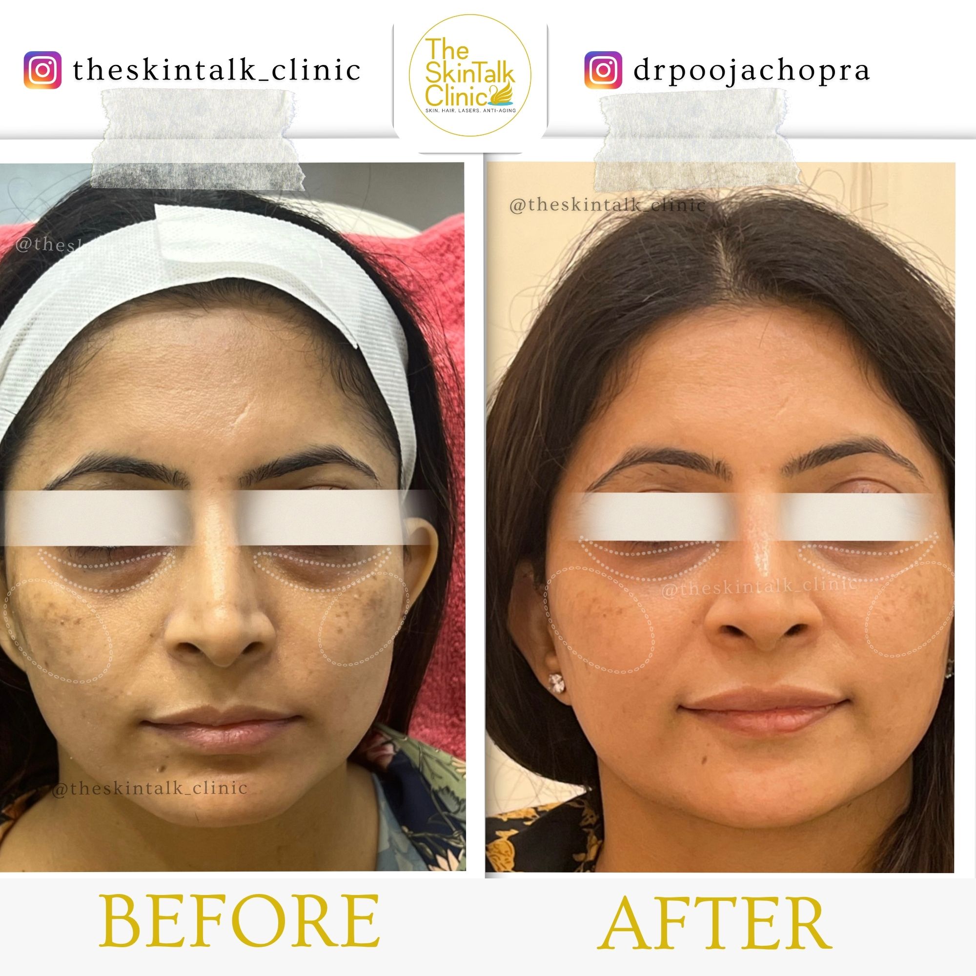 Skin Brightening